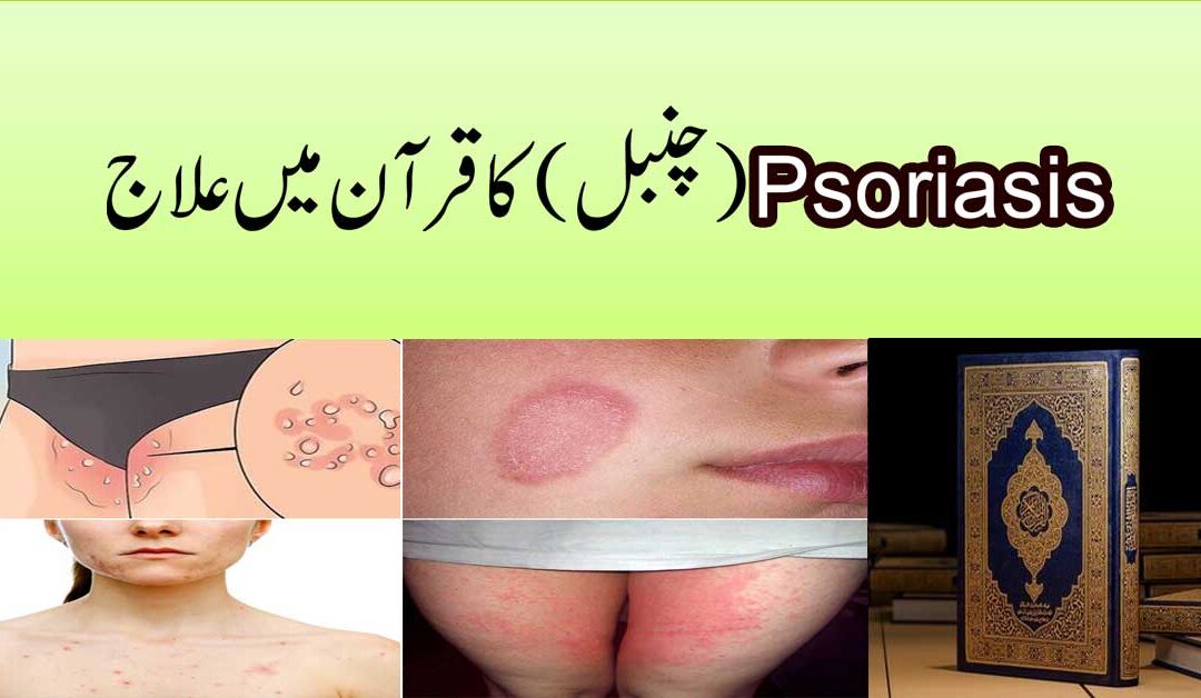 Chambal Ka 100% Ilaj Naqsh Se | Psoriasis Ka Ilaj In Quran